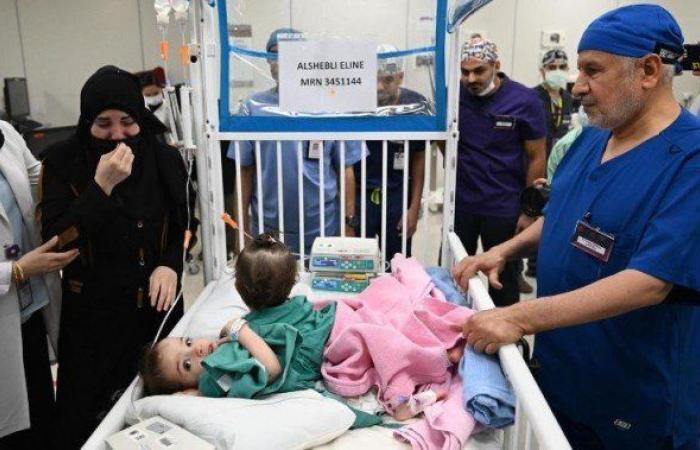 نجاح عملية فصل التوأم السيامي السوري «سيلين وإيلين»