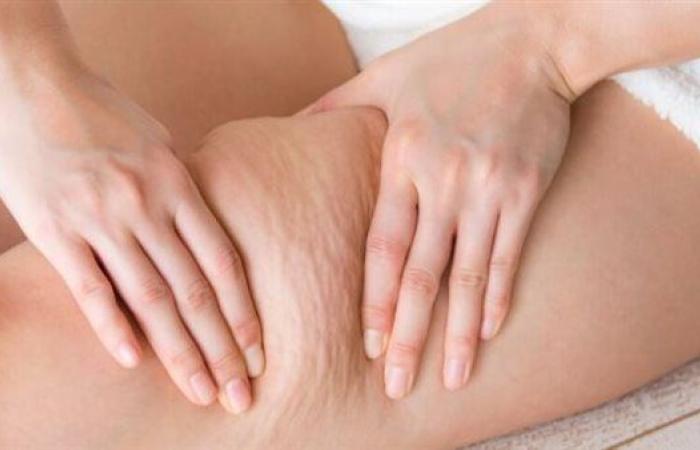 ما هي طرق الوقاية من ظهور السيلوليت على الجلد