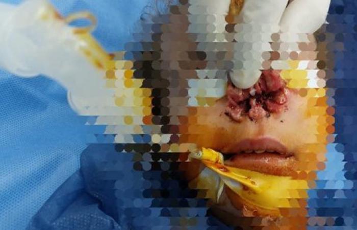 نجاح فريق جراحة الوجه والفكين بمستشفى قها في إنقاذ أنف طفلة من التشوه