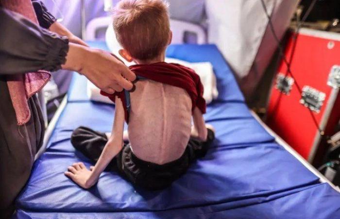 استشهاد 8 فلسطينين في غزة بينهم 5 بسبب التجويع وسوء التغذية
