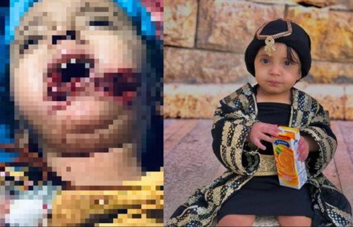 حادث مؤلم| كلب يلتهم فك طفلة وتخضع لـ3 عمليات جراحية.. والأم تستغيث بالحكومة