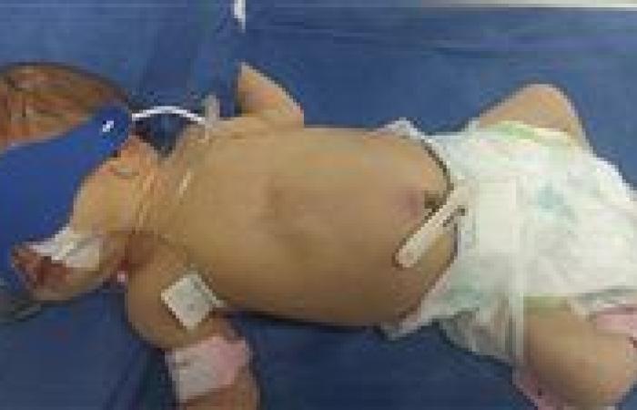 إنقاذ حياة رضيعة تعاني من انسداد معوي بمستشفى زاوية الناعورة بالمنوفية