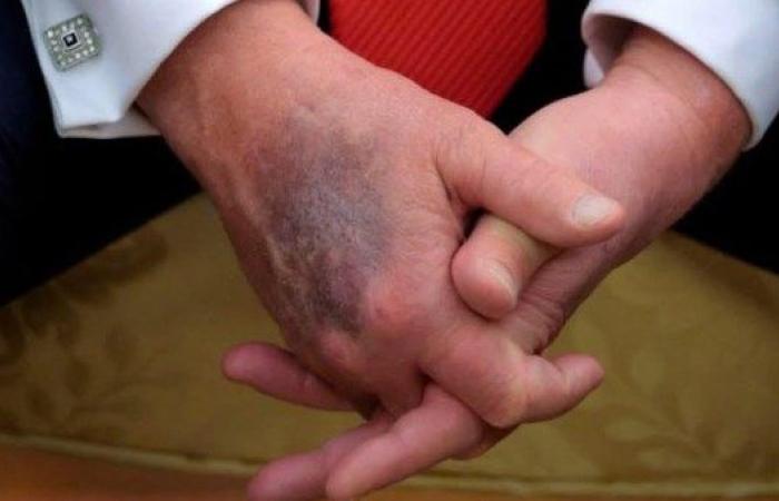 بعدما اعتاد إخفاءها بالمكياج.. كدمة كبيرة في يد ترامب تثير الجدل حول حالته الصحية
