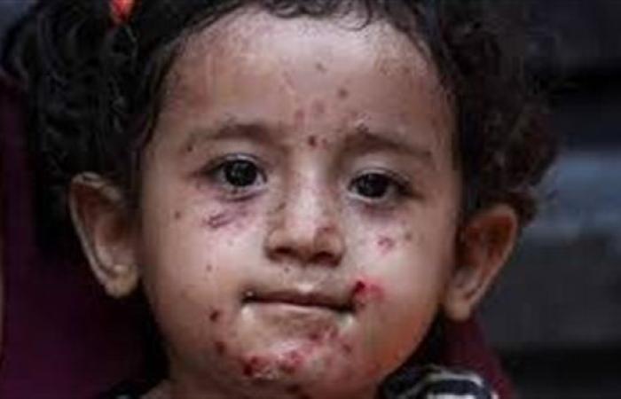 غزة تحتضر.. الحصار يطلق العنان لأمراض من زمن النسيان.. انتشار مرض عصبى نادر بين الأطفال.. و40 ألف إصابة بالالتهاب الكبدى
