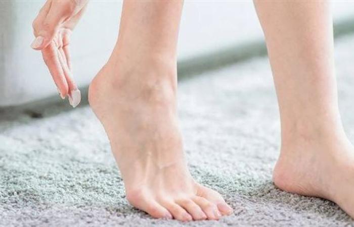 تشقق الكعبين في الصيف.. تعرف على الأسباب والعلاج بطرق طبيعية