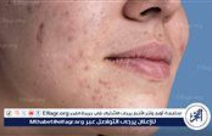 البشرة الدهنية.. بين المشاكل والحلول