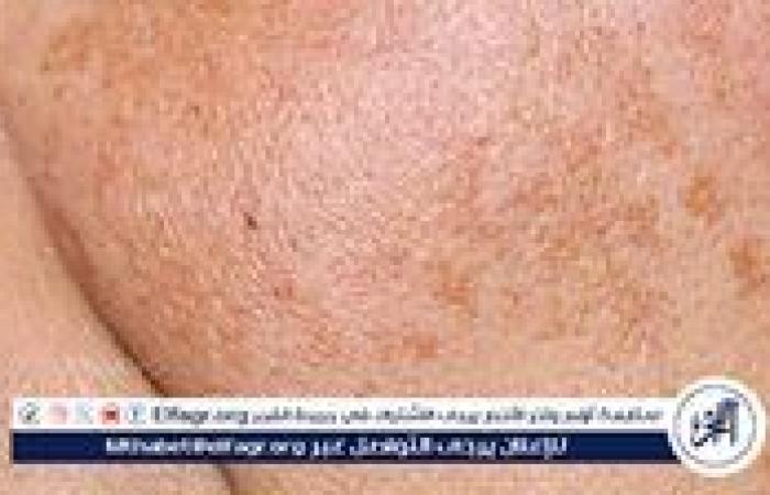 فوائد استخدام واقي الشمس.. درعك السري لصحة البشرة وجمالك الدائم