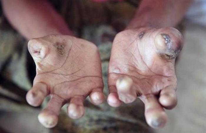 الصحة: مرض الجذام لا ينتقل بسهولة والعلاج متاح مجانًا ويحقق الشفاء الكامل