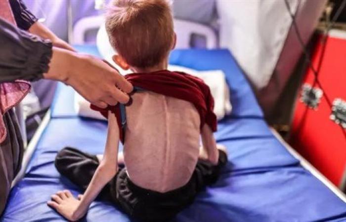 ارتفاع عدد الوفيات جراء الجوع وسوء التغذية في غزة إلى 18 حالة خلال 24 ساعة